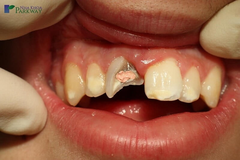 Mẻ răng nhẹ gây buốt, nặng có thể gây đau răng dữ dội