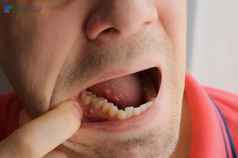 Đau răng do áp xe răng là tình trạng răng bị nhiễm trùng