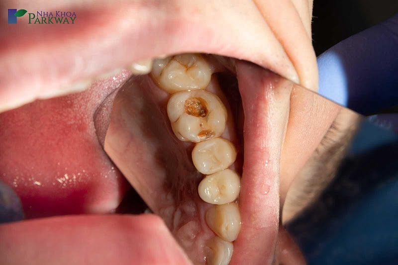 Răng bị sâu nặng và có nguy cơ bị hư hỏng cần phải nhổ nhanh chóng