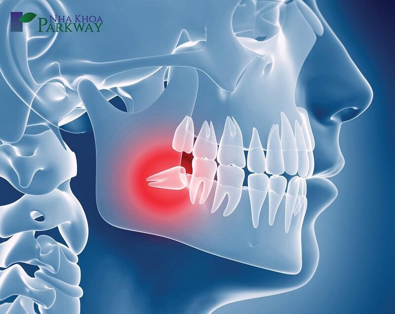 Răng khôn mọc sai vị trí cần phải nhổ bỏ để tránh gây đau răng