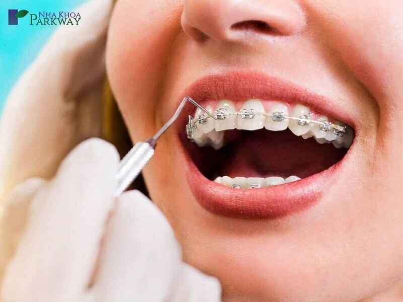 Một số trường hợp niềng răng cần nhổ răng để mang lại hiệu quả tốt nhất