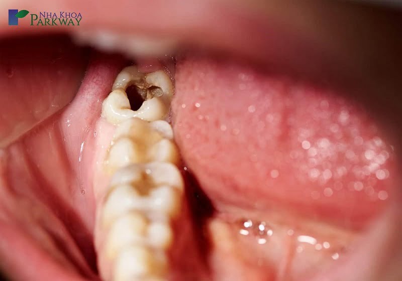 Lời giải đáp đang đau răng có nhổ được không là KHÔNG nếu răng của bạn đang bị nhiễm trùng nặng nề