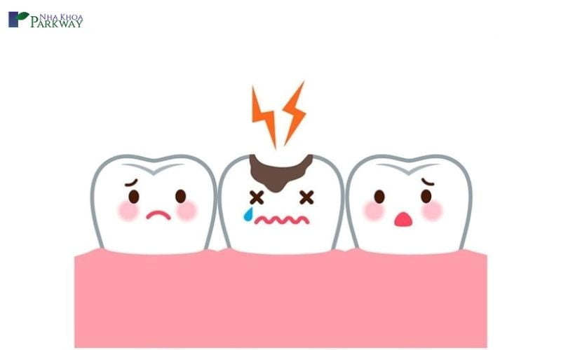 Gãy răng gây ra đau chân răng