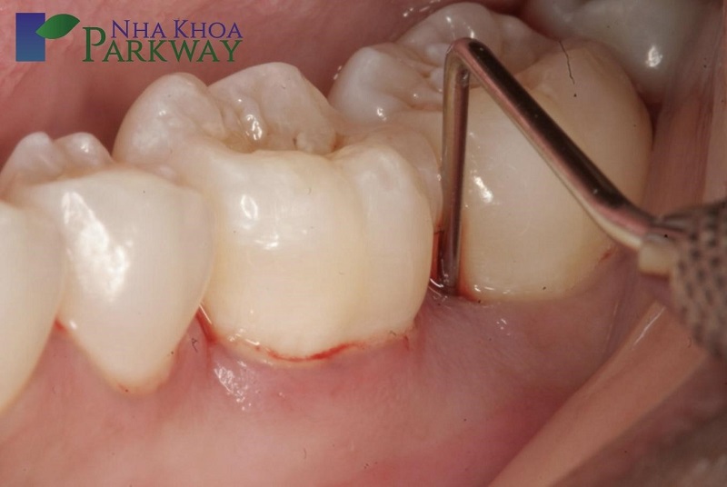 Tình trạng nướu bị tổn thương do mắc các bệnh lý về răng miệng
