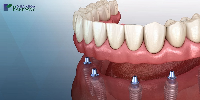Trồng răng Implant là phương pháp phục hồi chân răng hiệu quả