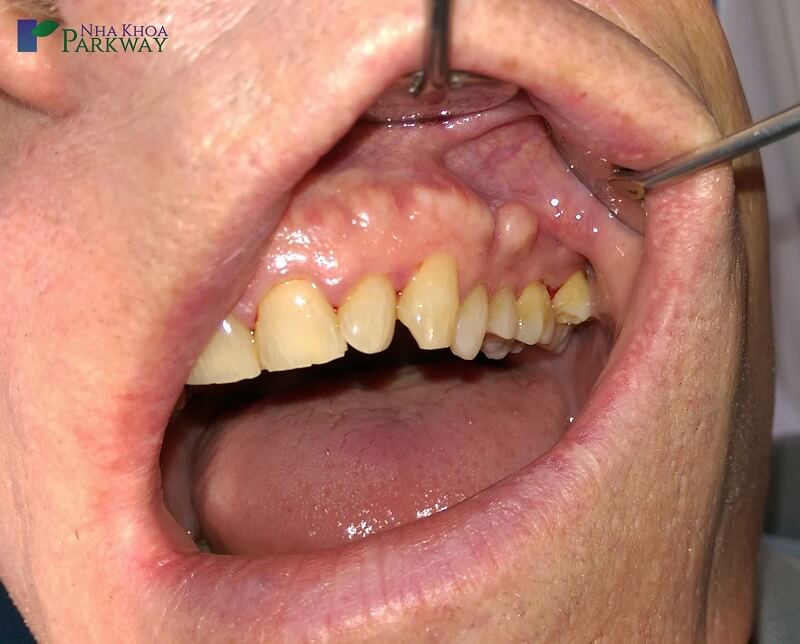 Lồi xương chân răng là khối u lành tính xuất hiện ở khu vực nướu bên ngoài chân răng