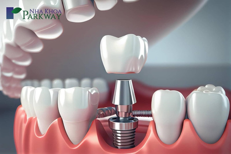 Sau khi điều trị u nang chân răng mức độ nặng, bác sĩ sẽ tiến hành trồng răng, trong đó nổi bật là phương pháp Implant