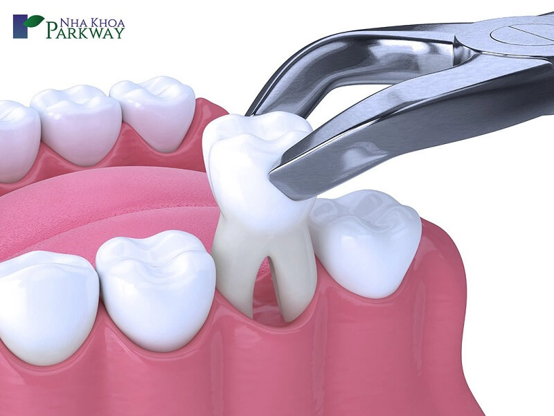 Có một số lý do bác sĩ chủ đích giữ lại một phần chân răng để an toàn cho bệnh nhân
