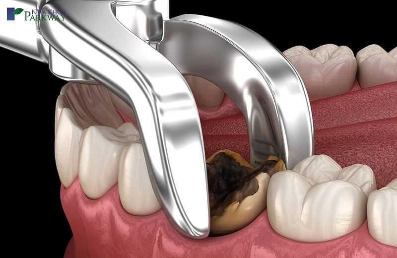 Nhổ chân răng còn sót lại trên răng có thể xảy ra do sự thiếu kinh nghiệm của nha sĩ