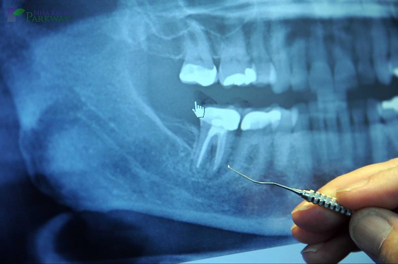 Người ta thường chụp X-quang để xác định có nhổ răng còn sót chân răng hay không