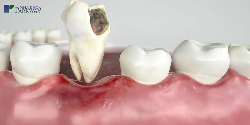 Các cách nhổ chân răng hàm dưới, hàm trên là để giảm nguy cơ lây lan khi răng bị viêm nhiễm