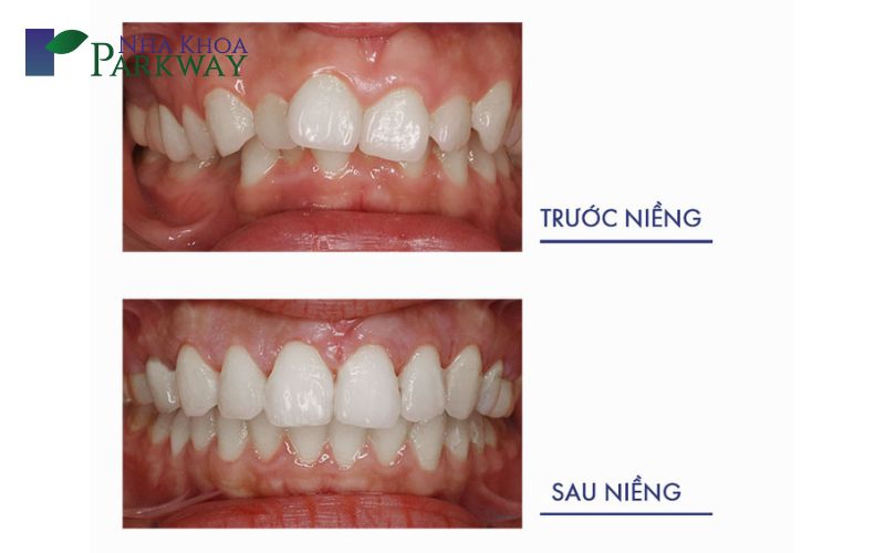 Niềng răng khấp khểnh được xem là phương pháp an toàn và bền vững nhất