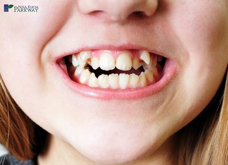 Theo y học thì răng khểnh 2 bên chính là một dạng sai lệch khớp cắn, gây nhiều tác hại cho sức khỏe răng miệng
