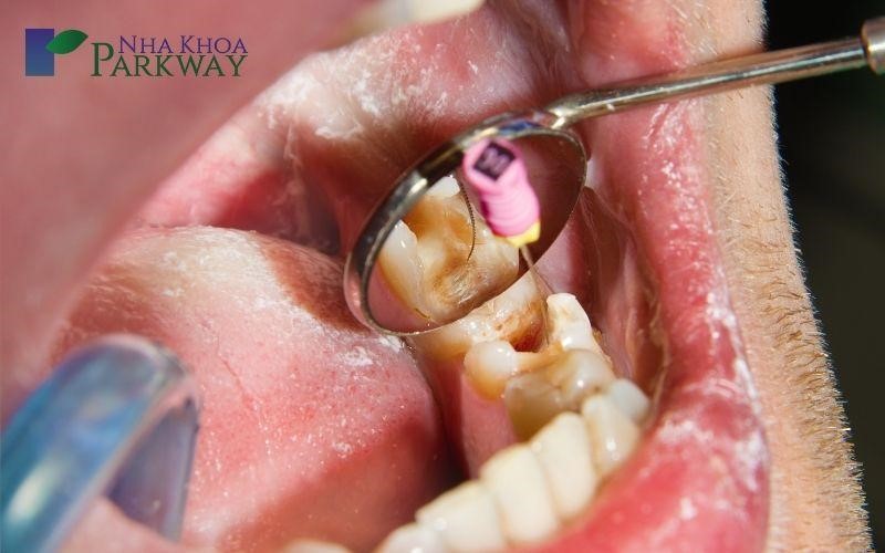 Sử dụng phương pháp lấy tủy răng để điều trị sâu chân răng