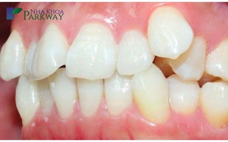 Răng mọc lệch cũng là một trong những nguyên nhân khiến chân răng bị sâu