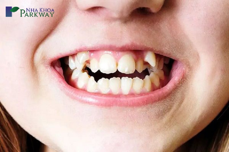 Con trai răng khểnh không phải lúc nào cũng tốt, một số trường hợp còn ảnh hưởng đến sức khỏe răng miệng
