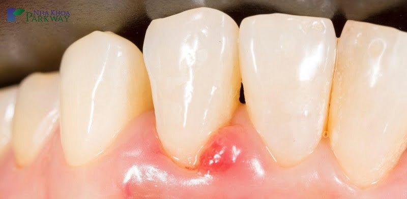 Viêm chân răng có mủ được biết đến là tình trạng tích tụ mủ ở chân răng