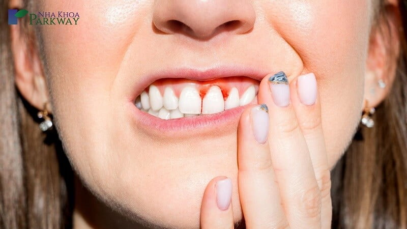 Viêm nha chu là một trong những nguyên nhân khiến cho chân răng có mủ trắng