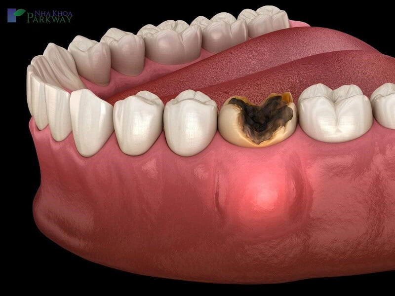 Bệnh của tủy răng là nguyên nhân gây viêm chân răng có mủ