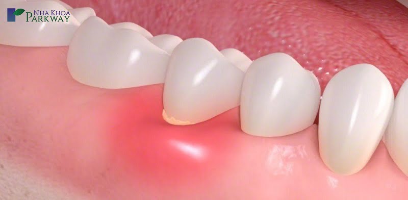 Điều trị viêm chân răng có mủ sau khi cô lập ổ nhiễm trùng