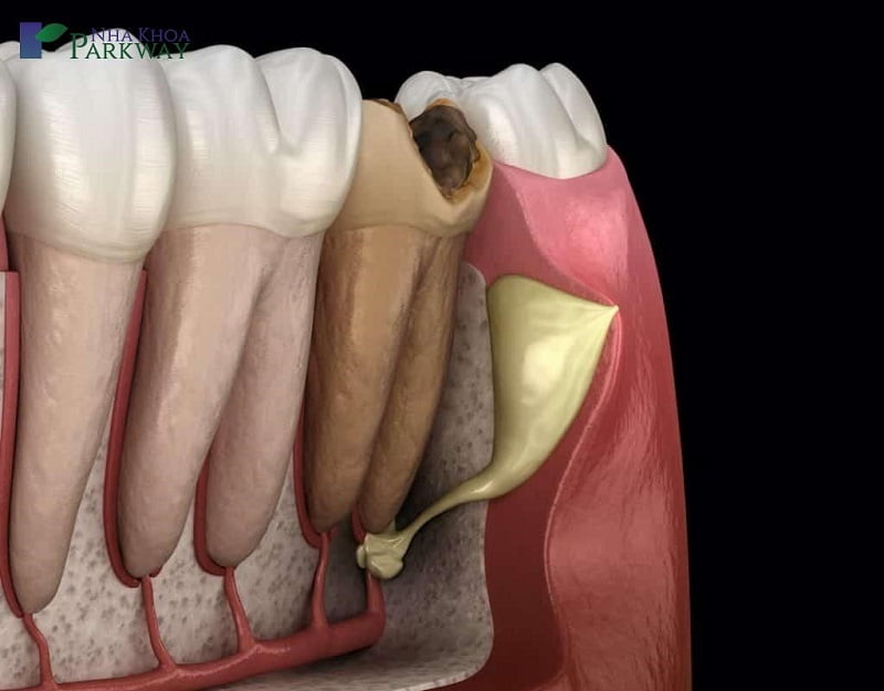Có nhiều thủ thuật để điều trị dứt điểm mủ chân răng