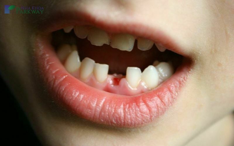 Răng cửa hàm dưới của trẻ em bị gãy