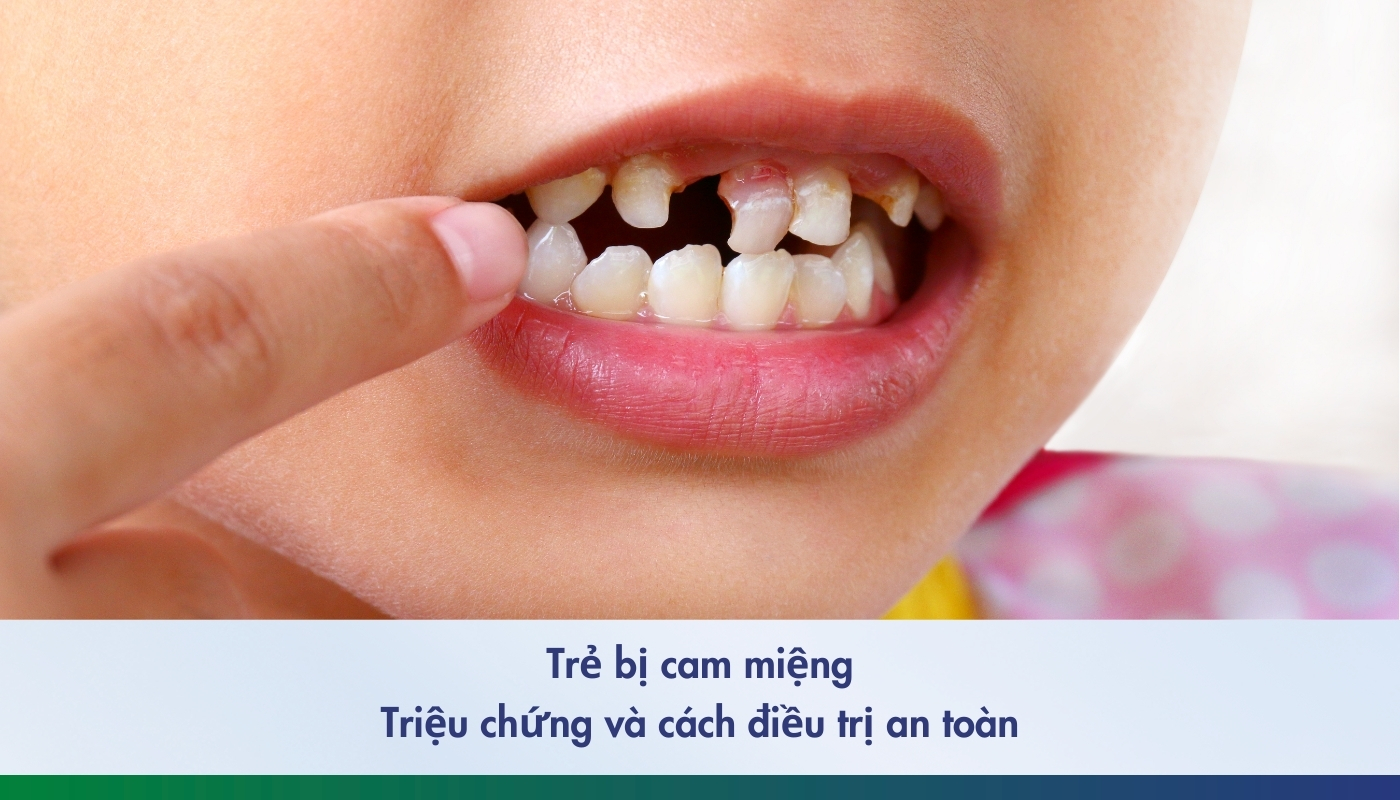 Trẻ 7 tuổi bị sâu răng hàm
