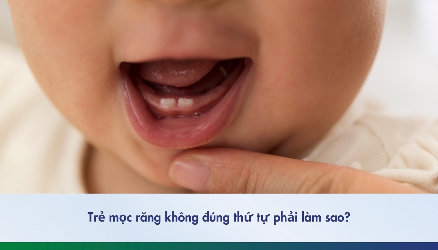 Trẻ mọc răng không đúng thứ tự cần xử lý thế nào?