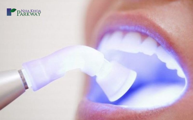 Sử dụng đèn chuyên dụng để làm trắng răng