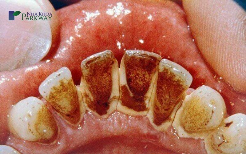 Mặt trong của hàm răng có nhiều vôi và mảng bám vàng