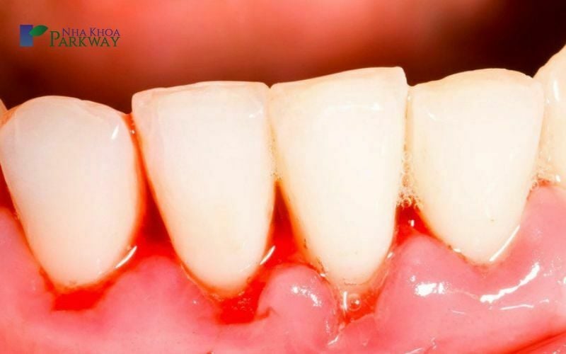 Những tác hại của cao răng màu đen và các mảng bám đen trên răng là gì?