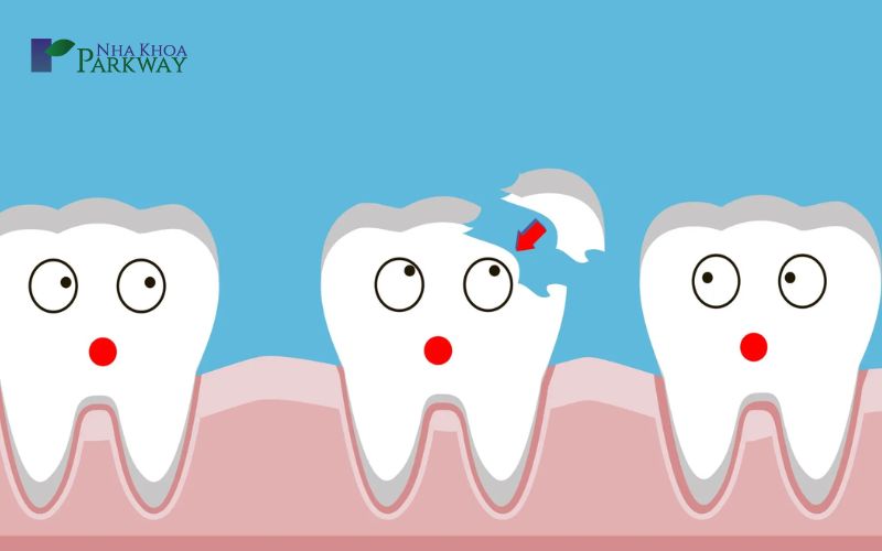 Răng hàm bị mẻ một bên răng