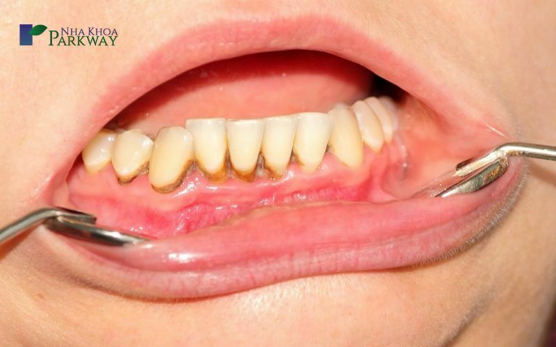 Tại sao nướu răng bị đen?