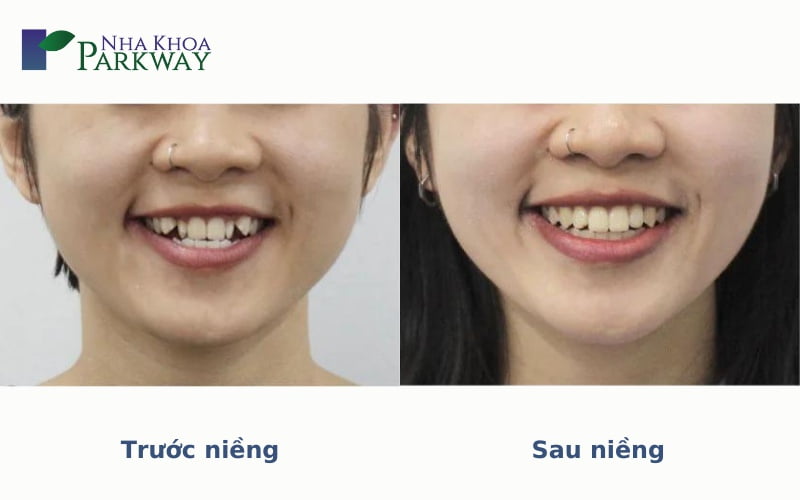 Khuôn mặt trước và sau khi niềng răng hô đối với mỗi trường hợp khác nhau