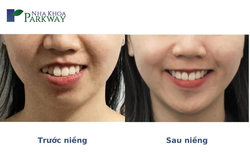 Khuôn mặt trước và sau khi niềng răng hô đối với mỗi trường hợp khác nhau