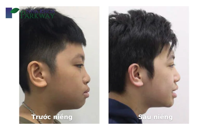 Khuôn mặt trước và sau khi niềng răng ở từng độ tuổi 