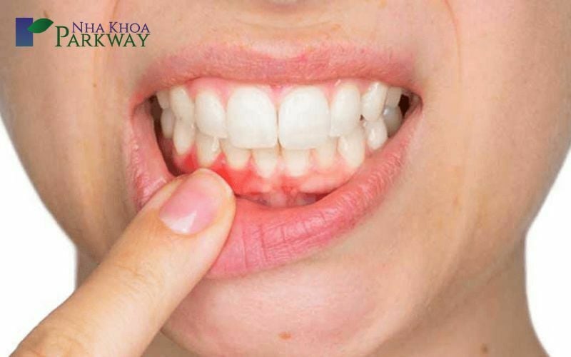 Các triệu chứng để nhận biết áp xe răng ở trẻ em