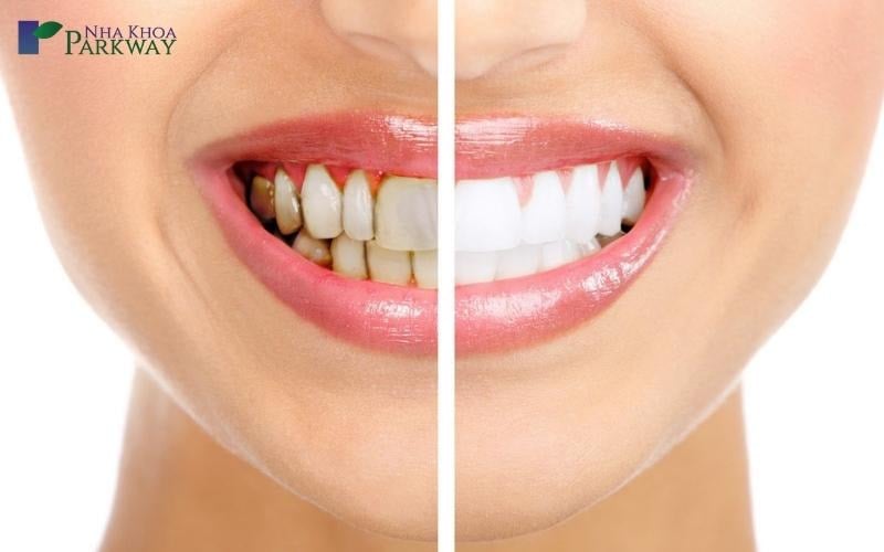 Hình ảnh răng của cô gái trước và sau khi tẩy trắng