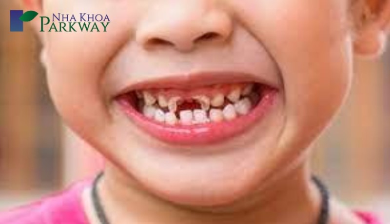 Em bé cười với 2 răng cửa bị sâu mất răng 1 phần