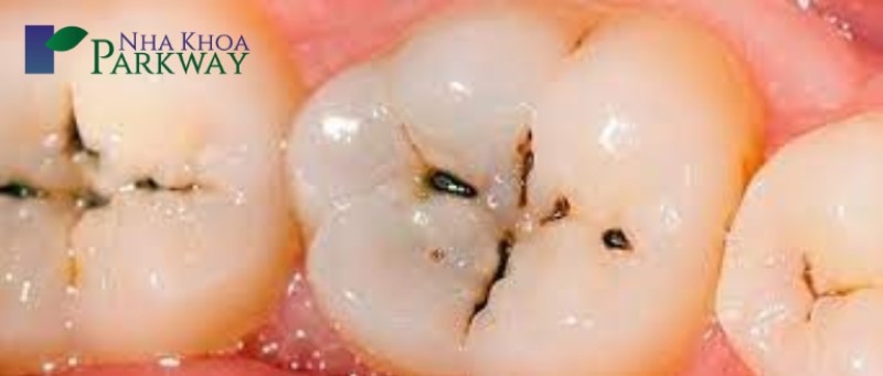 Bé bị sâu răng hàm sữa: Nguyên nhân, Tác hại và cách điều trị