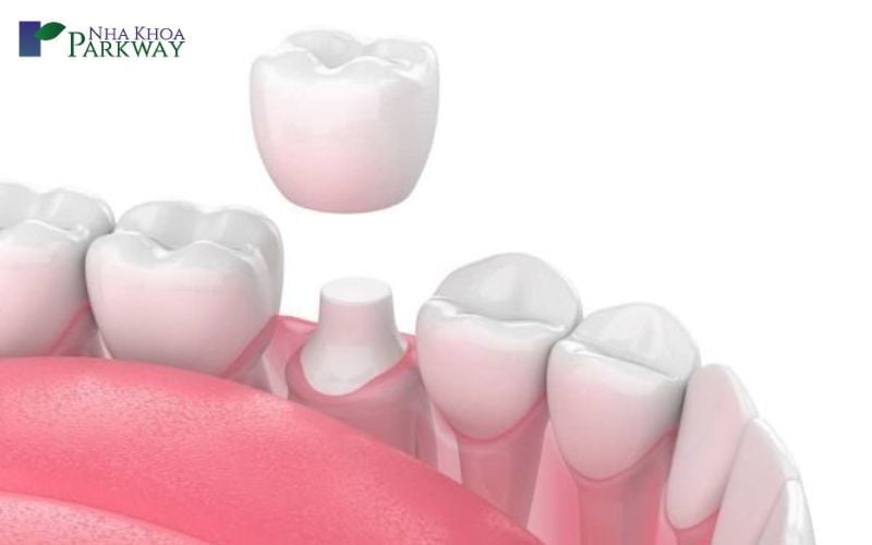 Bị rụng răng điều trị như thế nào tại nha khoa