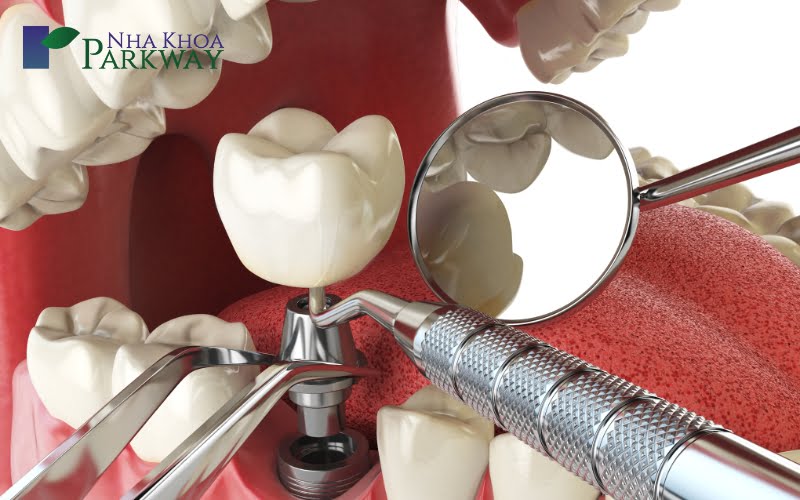 Trồng răng implant cái thiện tình trạng mất răng