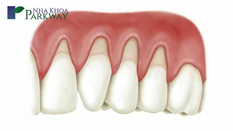 Bọc răng sứ kém chất lượng làm hở cổ chân răng có thể dẫn đến nhiều bệnh lý răng miệng khác