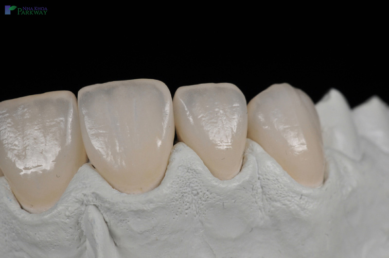 bọc răng sứ duy trì độ bền được bao lâu