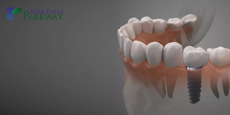 Mô phỏng so sánh giữa răng trồng Implant so với các chiếc răng thật