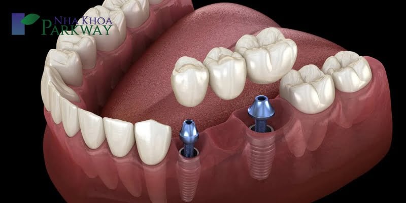 Mô phỏng quá trình trồng răng sứ Implant