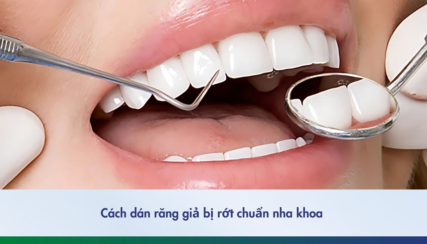 Cách dán răng giả bị rớt chuẩn nha khoa