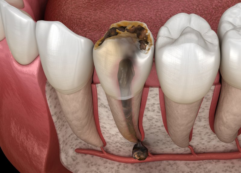 cách điều trị chứng viêm tủy răng có mủ