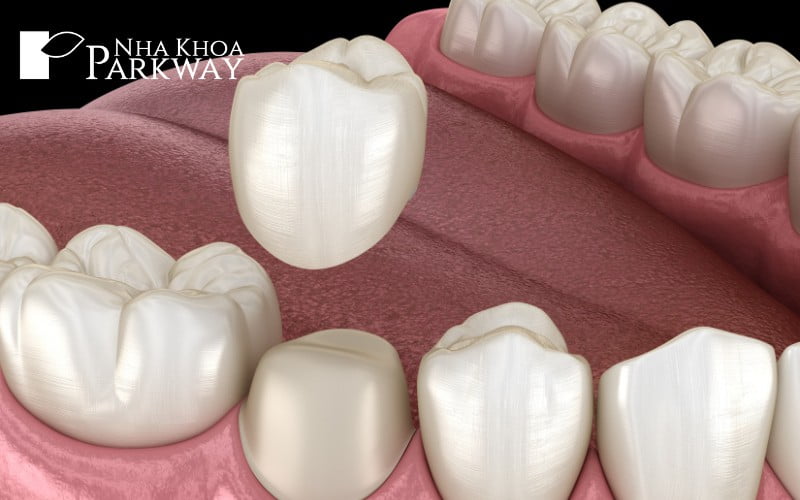 Những cách làm răng hết hô tại nha khoa vô cùng an toàn
