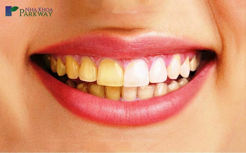 Răng bị ố vàng có tẩy trắng được không?